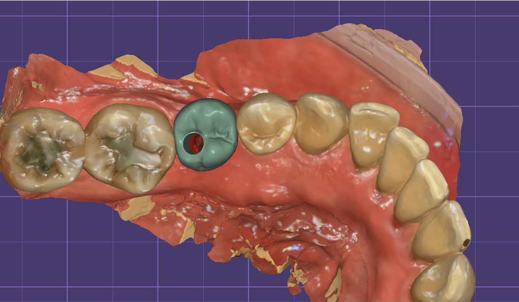 Implant Screw Retained/ Custom Abutment (JAPAN DESIGN) ( per unit)