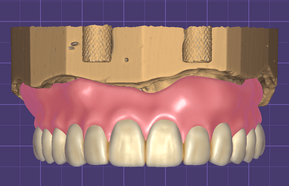 FULL DENTURE/ PARTIAL DENTURE (JAPAN DESIGN) ( per Arch)