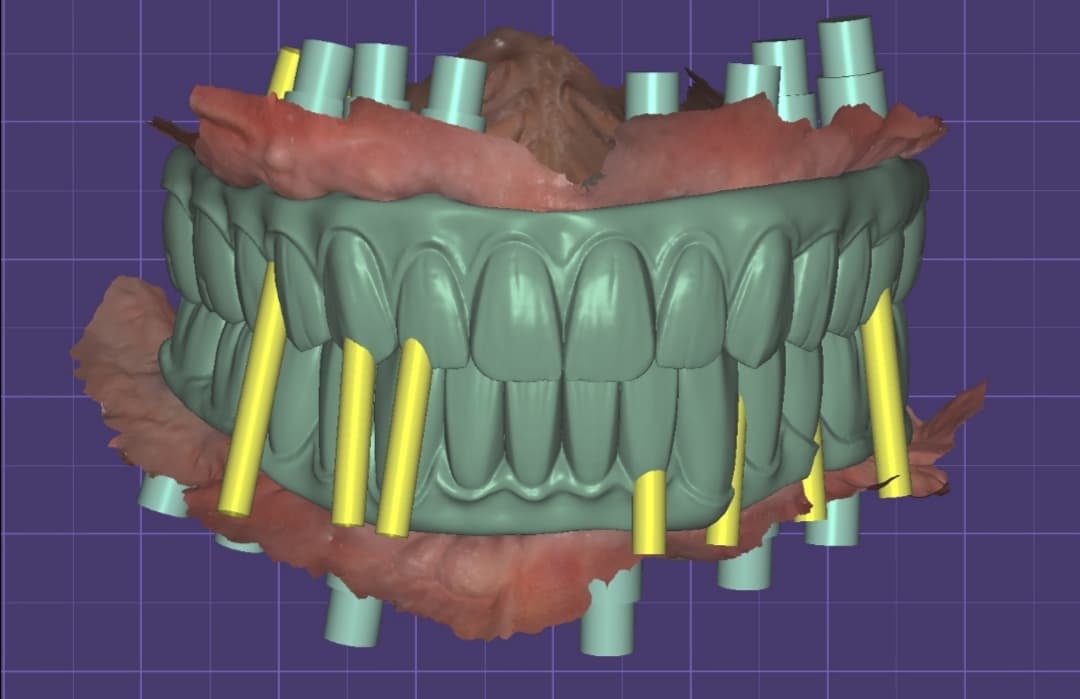 Professional Dental CAD Design | Crowns, Bridges & Full-Arch Implants (per unit)