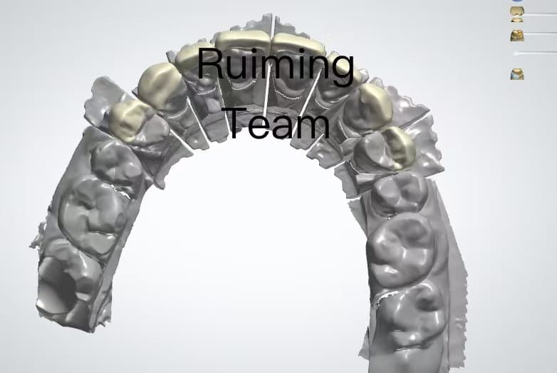 Dental Veneer CAD Design Service | 3Shape