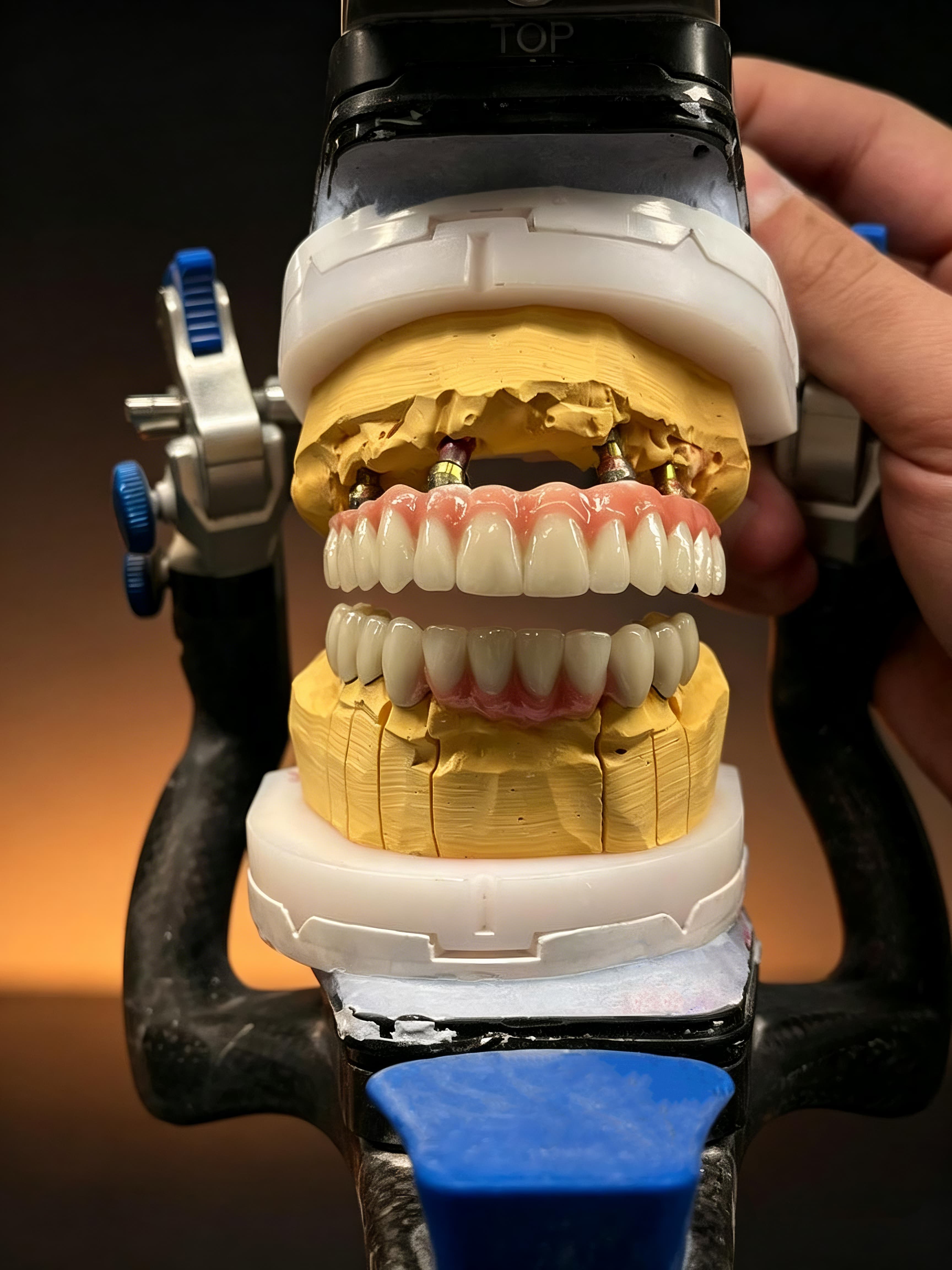 Shenzhen Dental Lab Direct Myy Dental Lab Services for Dentists | Crowns, Implants, Dentures