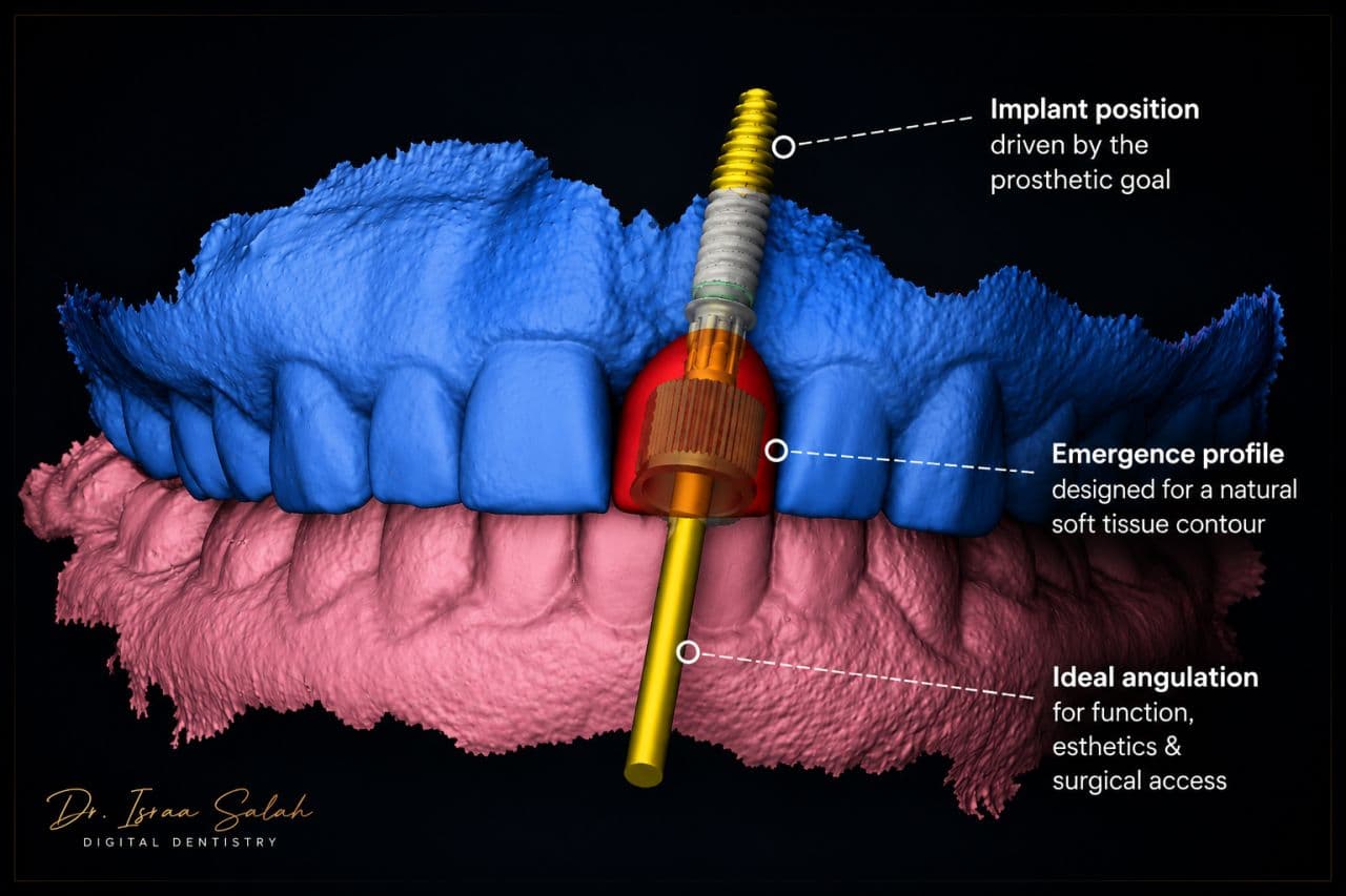 Digital Implant Planning & Surgical Guide Design | Prosthetically Driven Workflow