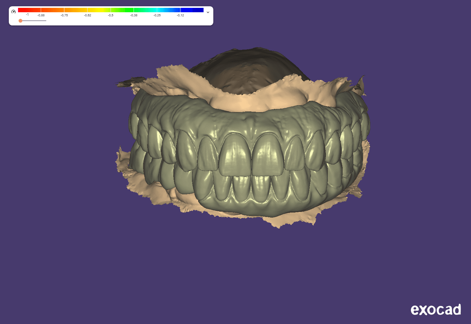Full-Arch Titanium Framework or Screw-Retained Zirconia